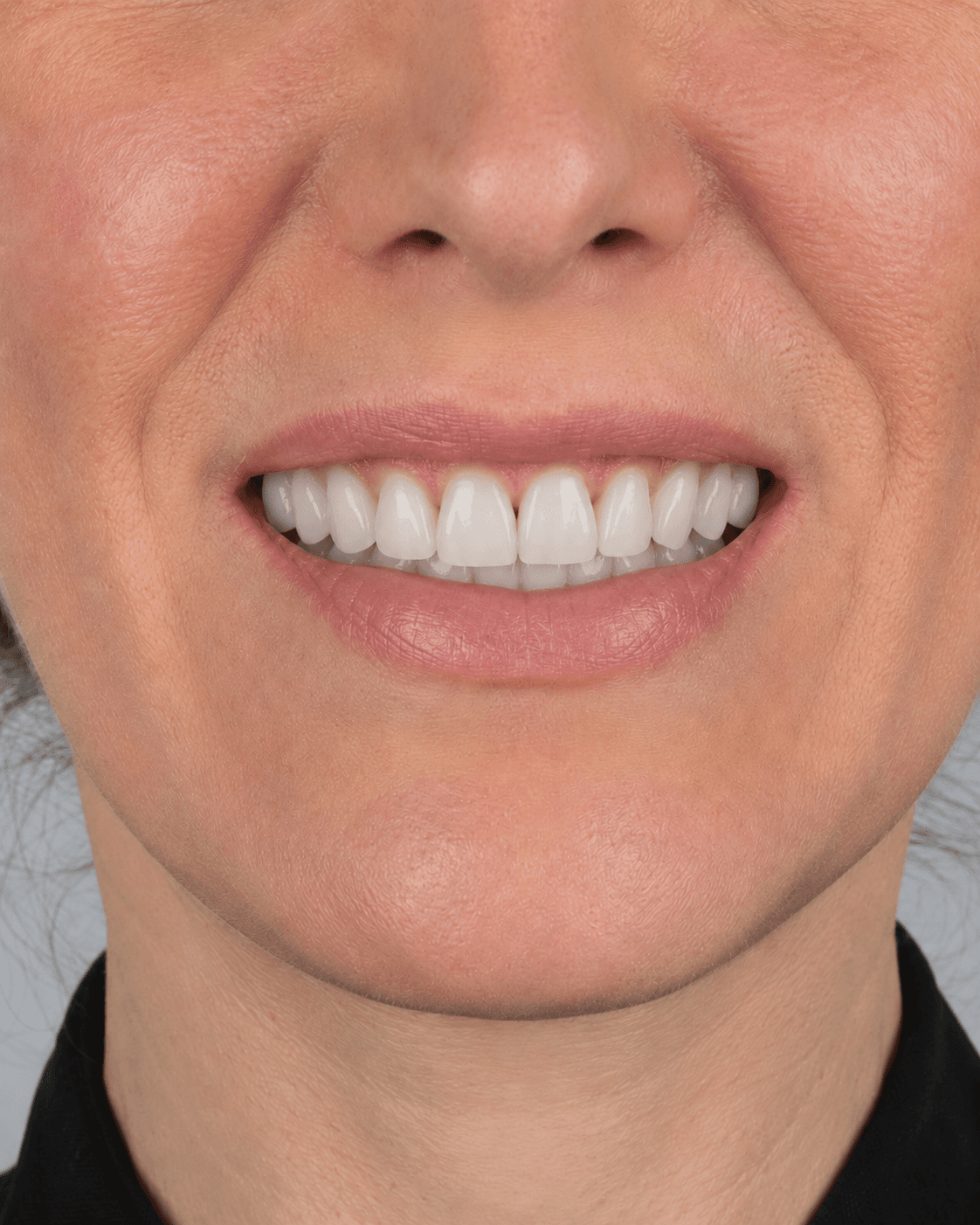 Después: sonrisa perfecta tras rehabilitación oral