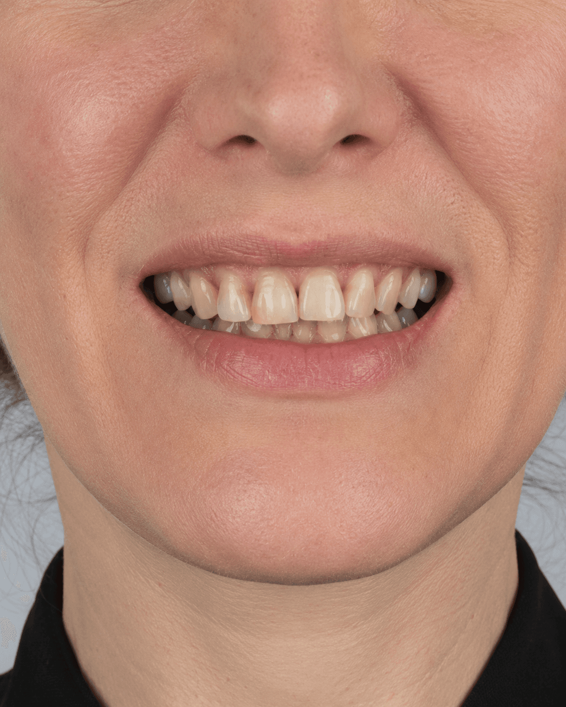 Antes: dentición con desgaste severo