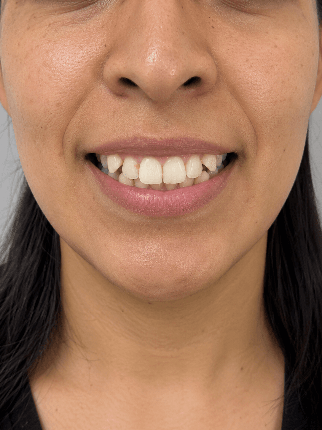 Antes: maloclusión y apiñamiento dental