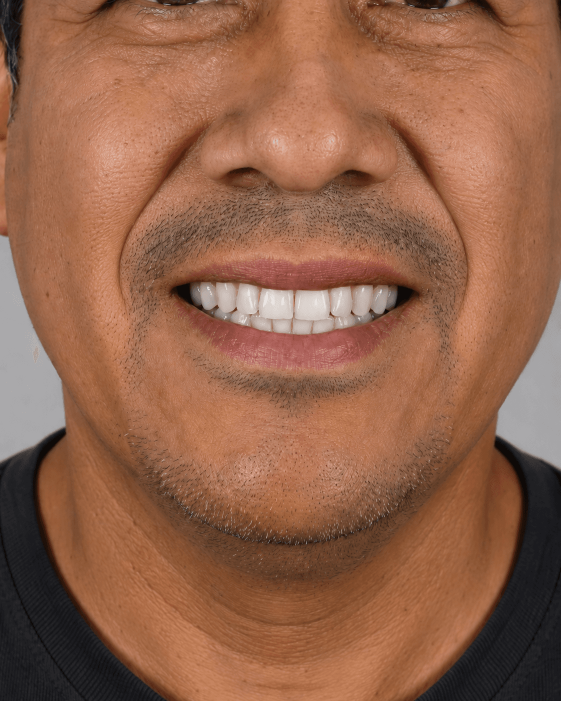 Después: dientes blancos tras blanqueamiento láser