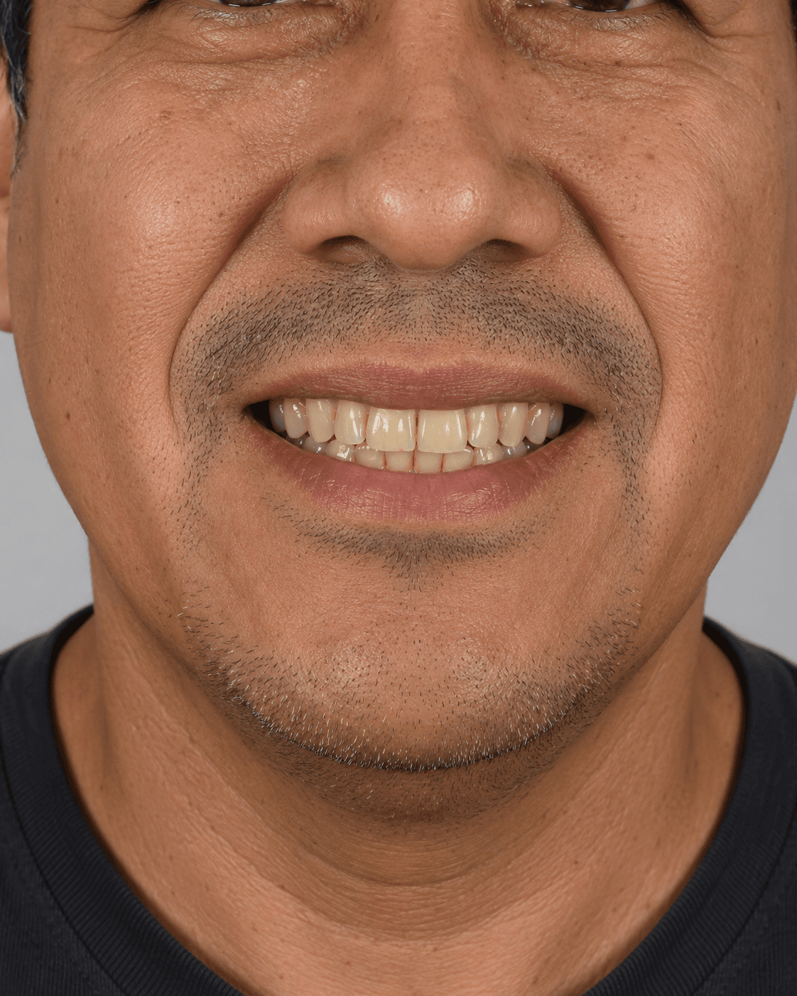 Antes: tinción dental por café y tabaco
